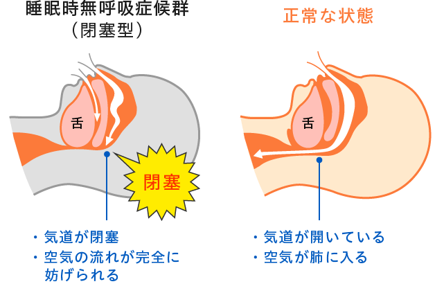 図：睡眠時無呼吸症候群(閉鎖型)と正常な状態の比較