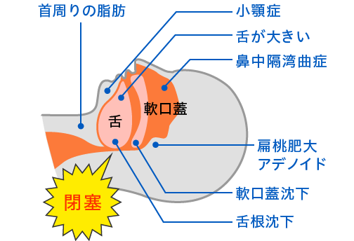 SASにかかりやすい人の特徴