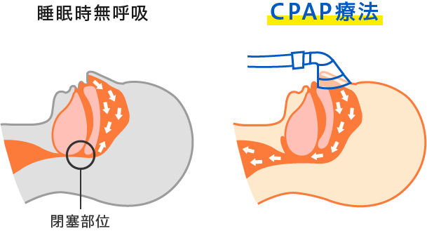 睡眠時無呼吸とCPAP治療の比較